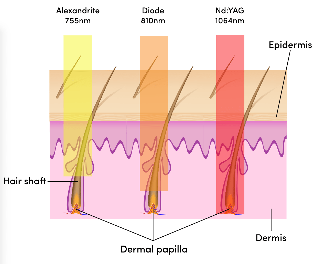 Medioq triple wave laser ontharen